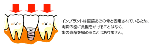 インプラントのメリット
天然歯と同じ食生活
残っている歯にやさしい治療
長期にわたっていい噛み合わせ
が維持できる。